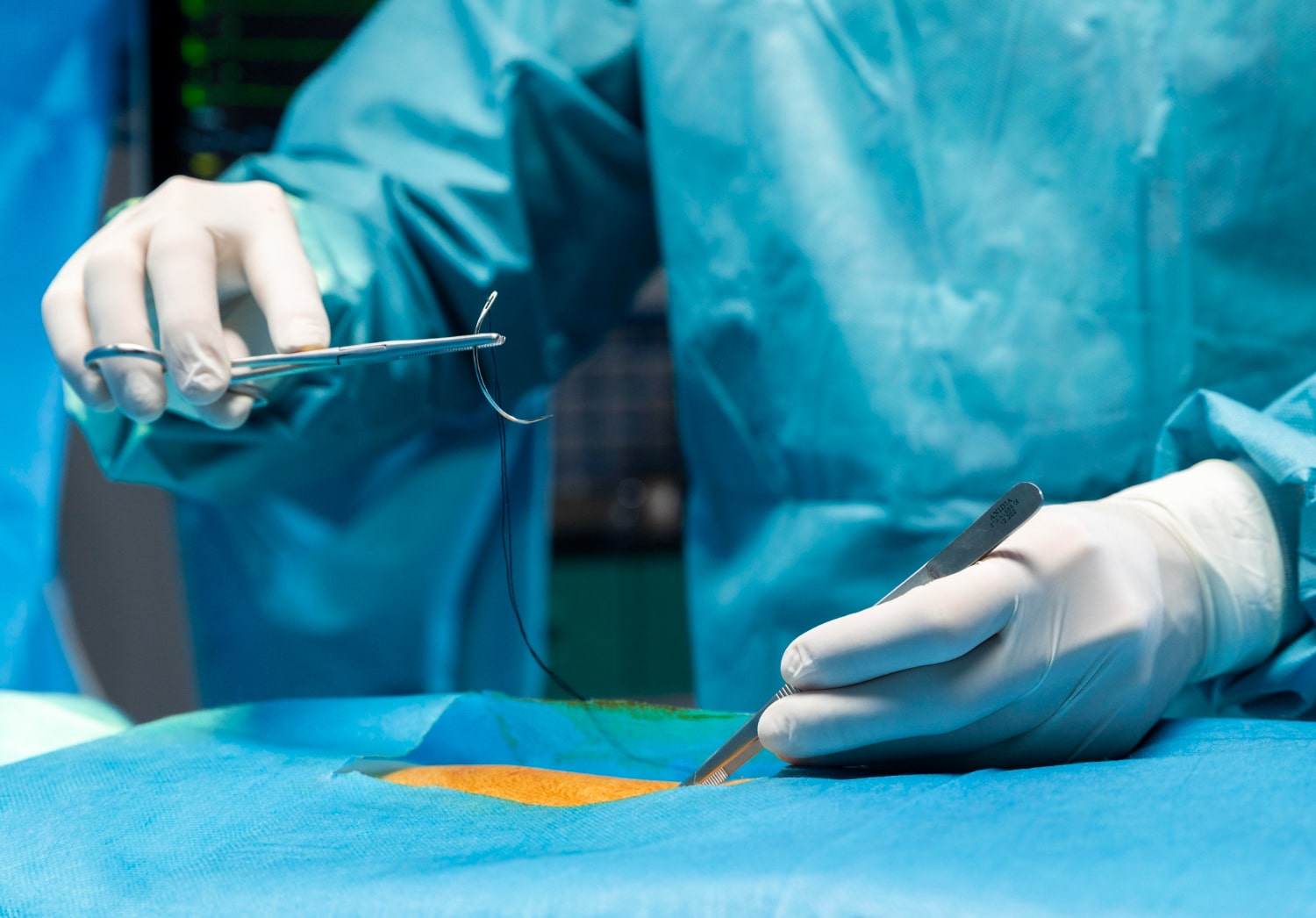 Close-up of ChondroHeal application during surgery, emphasizing its breakthrough in orthopedic and surgical healing.